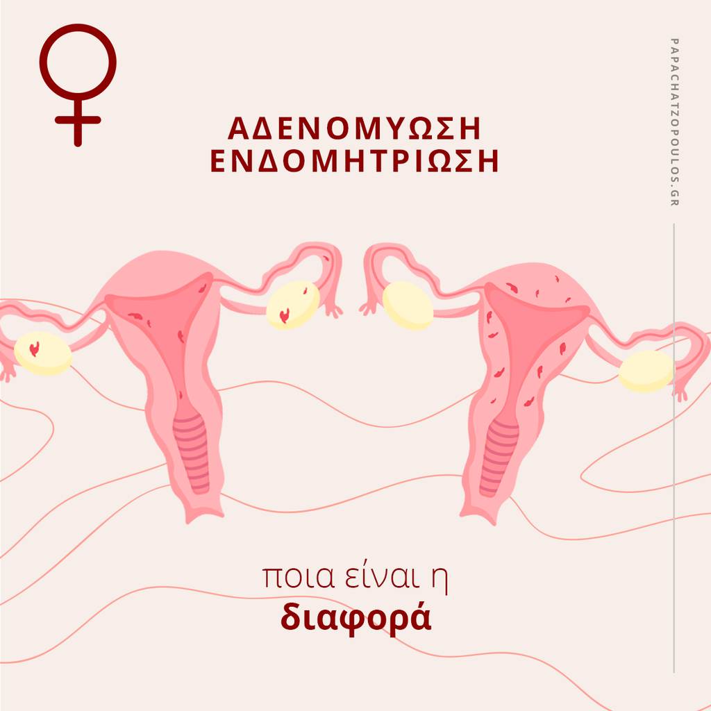 Αδενομύωση - Ενδομητρίωση, ποια είναι η διαφορά;